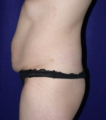 Tummy Tuck