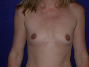 Breast Augmentation