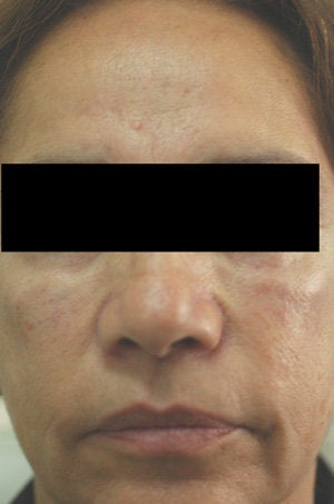Cheek Shaping with Juvederm Los Angeles Before and After Photos