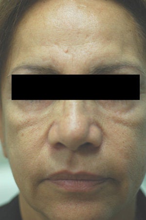Cheek Shaping with Juvederm Los Angeles Before and After Photos