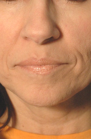 Juvederm for Mouth Rejuvenation 