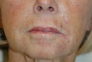 Juvederm for Smile Lines Long Beach, CA Before and After Pictures