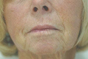 Juvederm for Smile Lines Long Beach, CA Before and After Pictures
