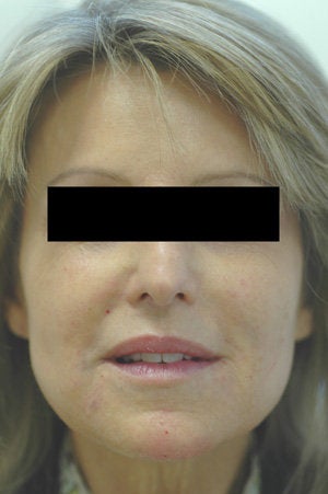 Laugh Lines with Juvederm in Anaheim, CA