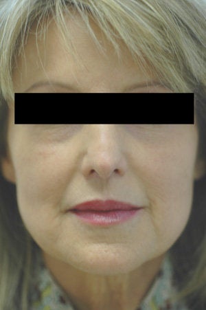 Laugh Lines with Juvederm in Anaheim, CA