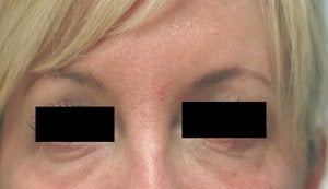 Bags under eyes before and after pictures Juvederm