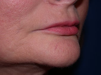 Injectable Fillers