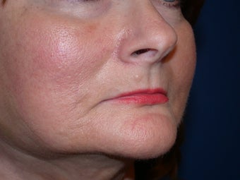 Injectable Fillers