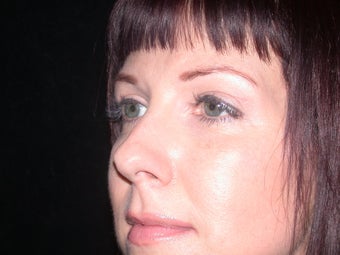 Brow Lift