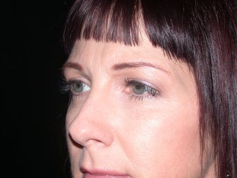 Brow Lift