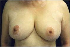 Breast Reduction