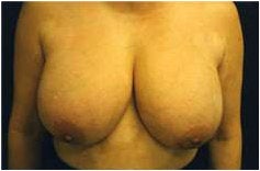 Breast Reduction
