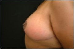 Breast Reduction