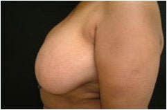 Breast Reduction
