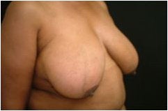 Breast Reduction