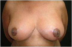 Breast Reduction