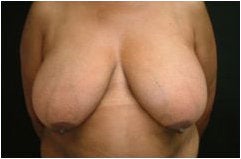 Breast Reduction