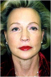 Facelift, Endoscopic Forehead Lift, Quadrilateral Blepharoplasty