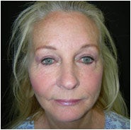 Facelift, Endoscopic Forehead Lift, Quadrilateral Blepharoplasty