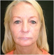 Facelift, Endoscopic Forehead Lift, Quadrilateral Blepharoplasty