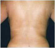 Liposuction
