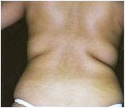 Liposuction