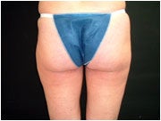 Liposuction