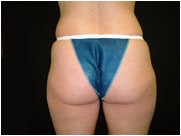 Liposuction