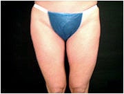 Liposuction