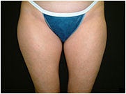 Liposuction