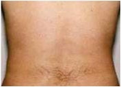 Liposuction