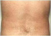 Liposuction