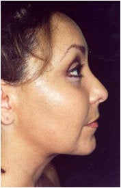 Endoscopic Facelift