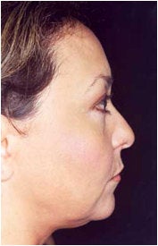 Endoscopic Facelift