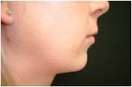Chin Augmentation