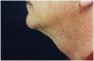 Chin Augmentation