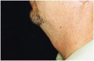 Chin Augmentation