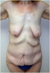 Body Lift