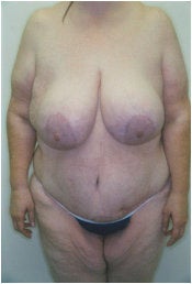 Body Lift Following Extreme Weight-Loss