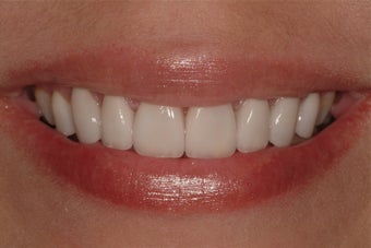 Porcelain Veneers