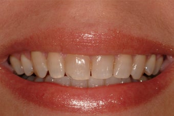Porcelain Veneers