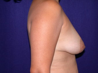 Breast Augmentation