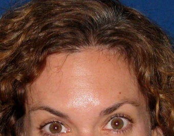 Botox