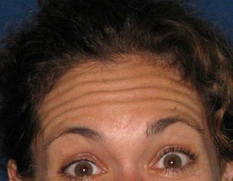 Botox