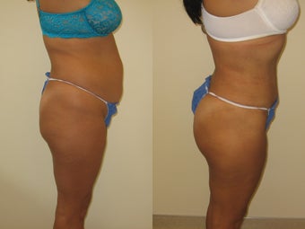 Brazilian butt lift