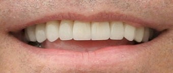 Porcelain Veneers Before and After (Smile Makeover)