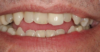 Porcelain Veneers Before and After (Smile Makeover)