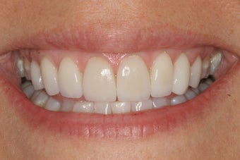 Smile Makeover with 8 Veneers