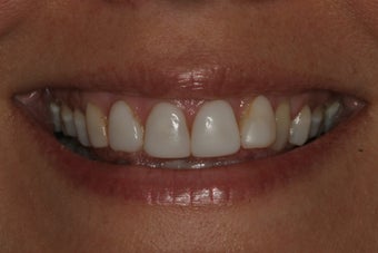 Smile Makeover with 8 Veneers