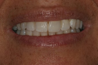 Invisalign 